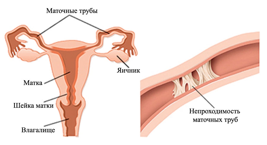 Непроходимость маточных труб: признаки и методы лечения
